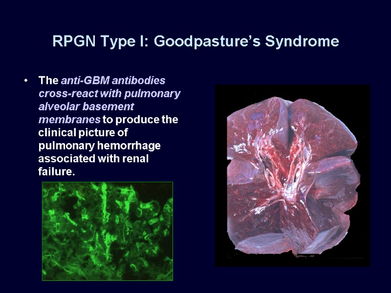 RPGN Type I: Goodpasture’s Syndrome The anti-GBM antibodies cross-react with pulmonary alveolar basement membranes